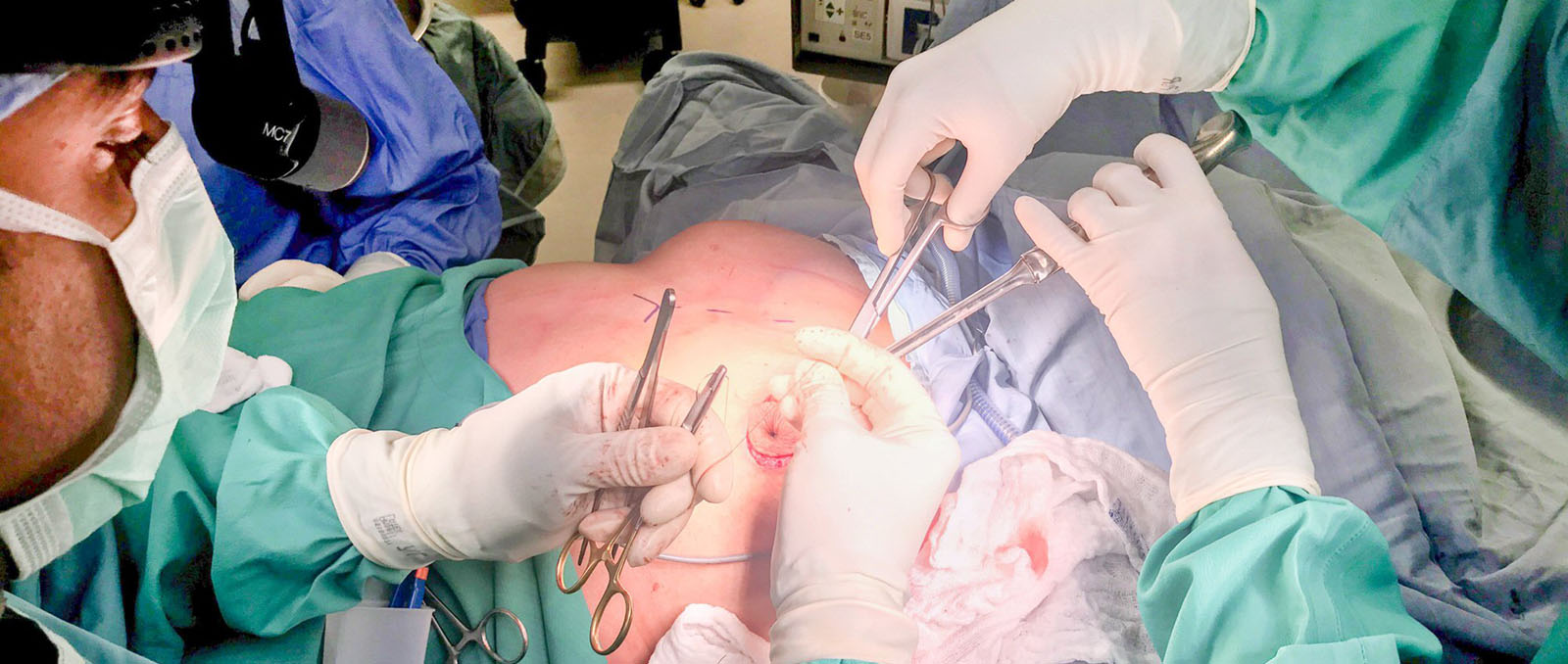 Tubuläre Brust – Brustchirurgie in Bochum: Ihre Experten für Körperformung